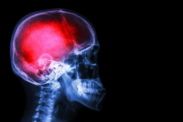 us-army-research-may-improve-stroke-tbi-treatment-defencetalk